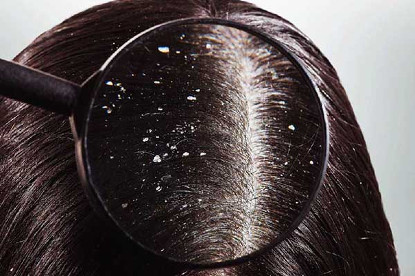 Giai đoạn của nấm da đầu