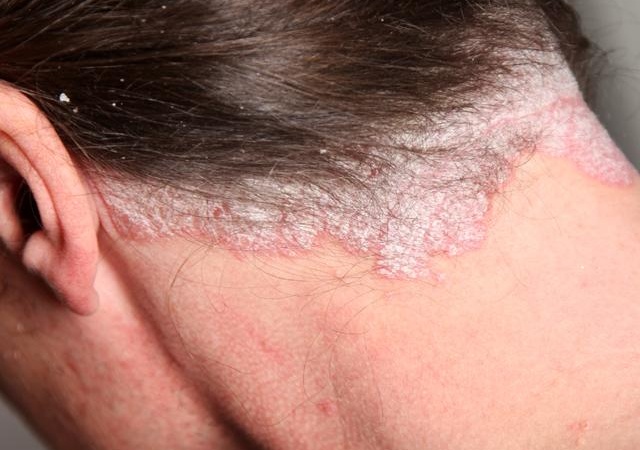 Giai đoạn 3: Rụng tóc nhiều - các giai đoạn của nấm da đầu